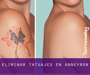 Eliminar tatuajes en Anneyron