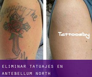 Eliminar tatuajes en Antebellum North