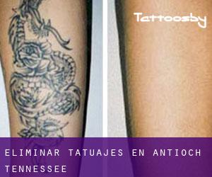 Eliminar tatuajes en Antioch (Tennessee)