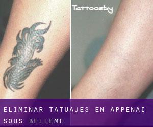 Eliminar tatuajes en Appenai-sous-Bellême