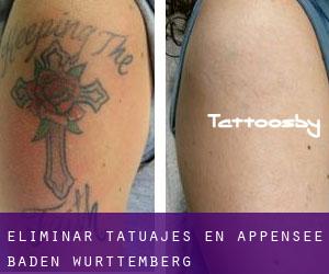 Eliminar tatuajes en Appensee (Baden-Württemberg)