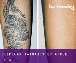 Eliminar tatuajes en Apple Spur