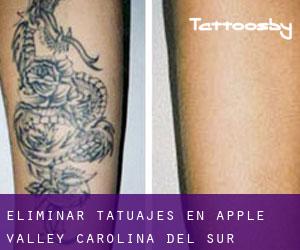 Eliminar tatuajes en Apple Valley (Carolina del Sur)