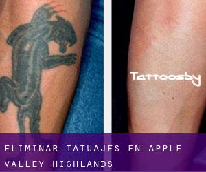 Eliminar tatuajes en Apple Valley Highlands