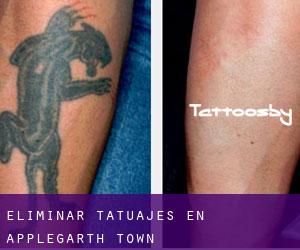 Eliminar tatuajes en Applegarth Town