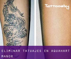 Eliminar tatuajes en Aquahart Manor