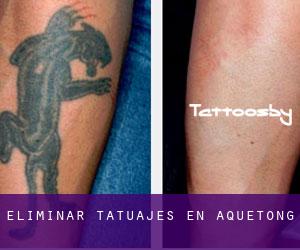 Eliminar tatuajes en Aquetong
