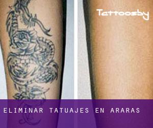 Eliminar tatuajes en Araras