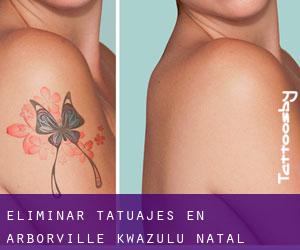 Eliminar tatuajes en Arborville (KwaZulu-Natal)