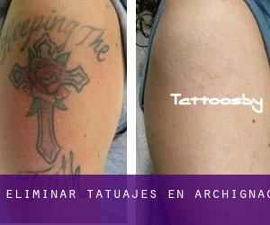 Eliminar tatuajes en Archignac