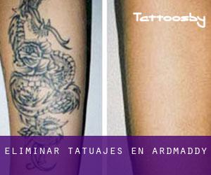 Eliminar tatuajes en Ardmaddy
