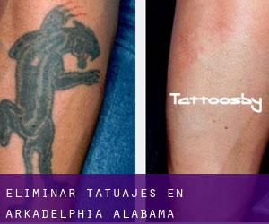 Eliminar tatuajes en Arkadelphia (Alabama)