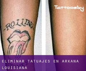 Eliminar tatuajes en Arkana (Louisiana)