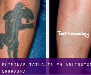 Eliminar tatuajes en Arlington (Nebraska)
