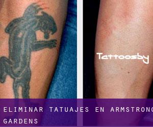 Eliminar tatuajes en Armstrong Gardens