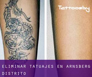 Eliminar tatuajes en Arnsberg Distrito