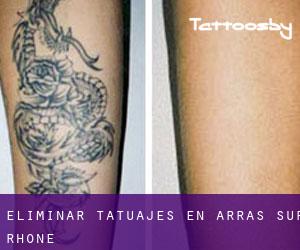 Eliminar tatuajes en Arras-sur-Rhône