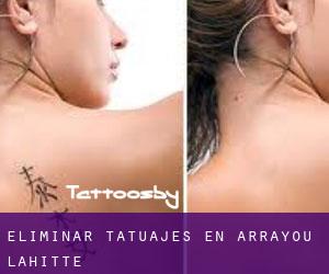 Eliminar tatuajes en Arrayou-Lahitte