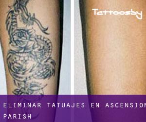 Eliminar tatuajes en Ascension Parish