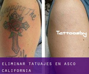 Eliminar tatuajes en Asco (California)