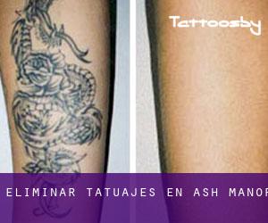 Eliminar tatuajes en Ash Manor