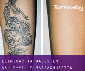 Eliminar tatuajes en Ashleyville (Massachusetts)