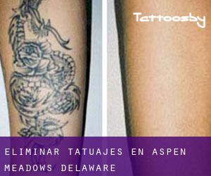 Eliminar tatuajes en Aspen Meadows (Delaware)