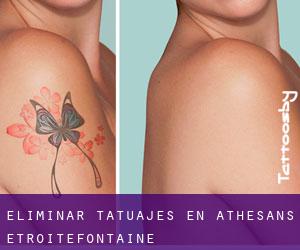 Eliminar tatuajes en Athesans-Étroitefontaine