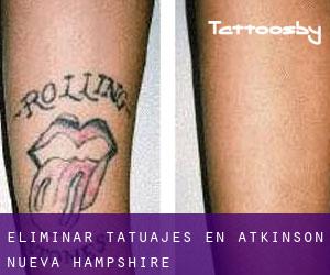 Eliminar tatuajes en Atkinson (Nueva Hampshire)