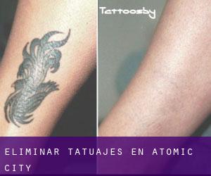 Eliminar tatuajes en Atomic City