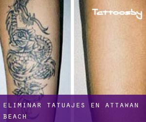 Eliminar tatuajes en Attawan Beach