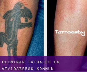 Eliminar tatuajes en Åtvidabergs Kommun