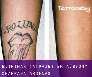 Eliminar tatuajes en Aubigny (Champaña-Ardenas)