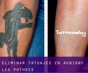 Eliminar tatuajes en Aubigny-les-Pothées