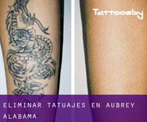 Eliminar tatuajes en Aubrey (Alabama)
