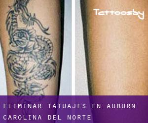 Eliminar tatuajes en Auburn (Carolina del Norte)