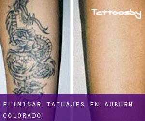 Eliminar tatuajes en Auburn (Colorado)