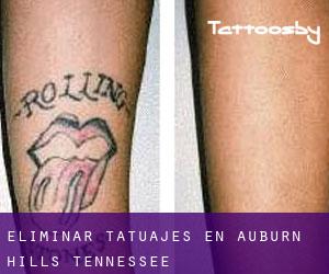 Eliminar tatuajes en Auburn Hills (Tennessee)