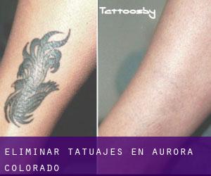 Eliminar tatuajes en Aurora (Colorado)