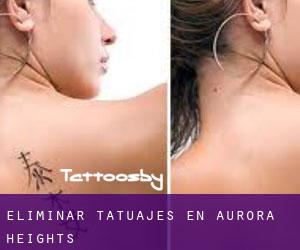 Eliminar tatuajes en Aurora Heights