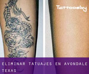 Eliminar tatuajes en Avondale (Texas)