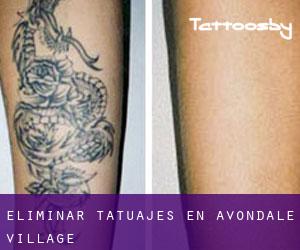 Eliminar tatuajes en Avondale Village