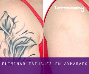 Eliminar tatuajes en Aymaraes
