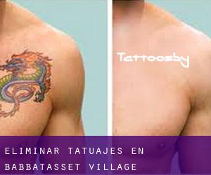 Eliminar tatuajes en Babbatasset Village