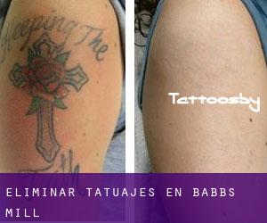 Eliminar tatuajes en Babbs Mill