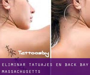Eliminar tatuajes en Back Bay (Massachusetts)