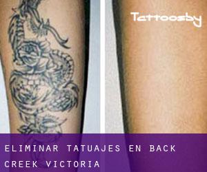 Eliminar tatuajes en Back Creek (Victoria)