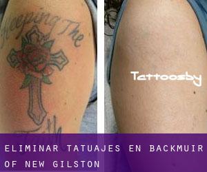 Eliminar tatuajes en Backmuir of New Gilston