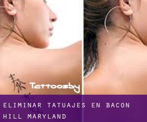 Eliminar tatuajes en Bacon Hill (Maryland)