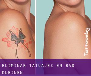 Eliminar tatuajes en Bad Kleinen
